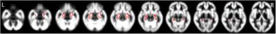 Possibility of Enlargement in Left Medial Temporal Areas Against Cerebral Amyloid Deposition Observed During <mark class="highlighted">Preclinical Stage</mark>